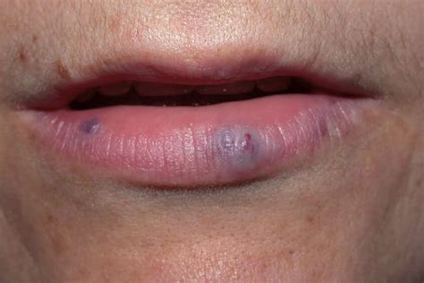 <b>Purple</b> marks on <b>lips</b>: You have to see your doctor or a dermatologist to have a proper diagnosis. . Purple spot on lip pictures